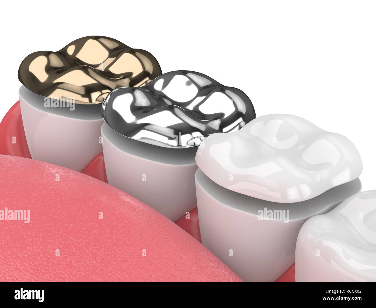 3d render of jaw with teeth and three types of onlay over white Stock ...
