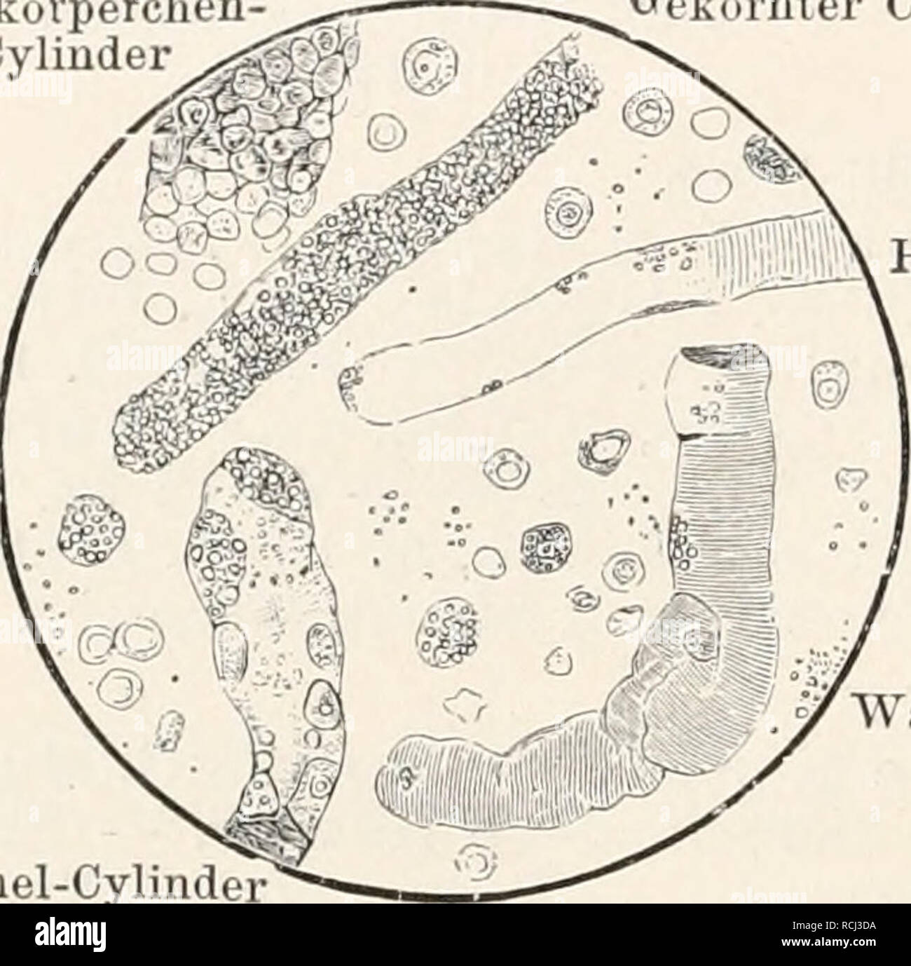 . Die Leukämie als Protozoeninfektion; Untersuchungen zur Ätiologie und Pathologie. Verlag von J. F. Bergmann in Wiesbaden. Taschenbuch der Medizinisch-Klinischen Diagnostik. Dr. Otto Seifert, Professor in Würzburg. Von nnd Dr. Friedr. Müller, Professor in Basel. Zehnte verbesserte und vermehrte Auflage. Mit Abbildungen. In englischem Einband. Preis M. 4.- Blutkörperchen Cylinder Gekörnter Cylinder. Hyaliner Cylinder aehsartiger Cylinder. Please note that these images are extracted from scanned page images that may have been digitally enhanced for readability - coloration and appearance of the Stock Photo