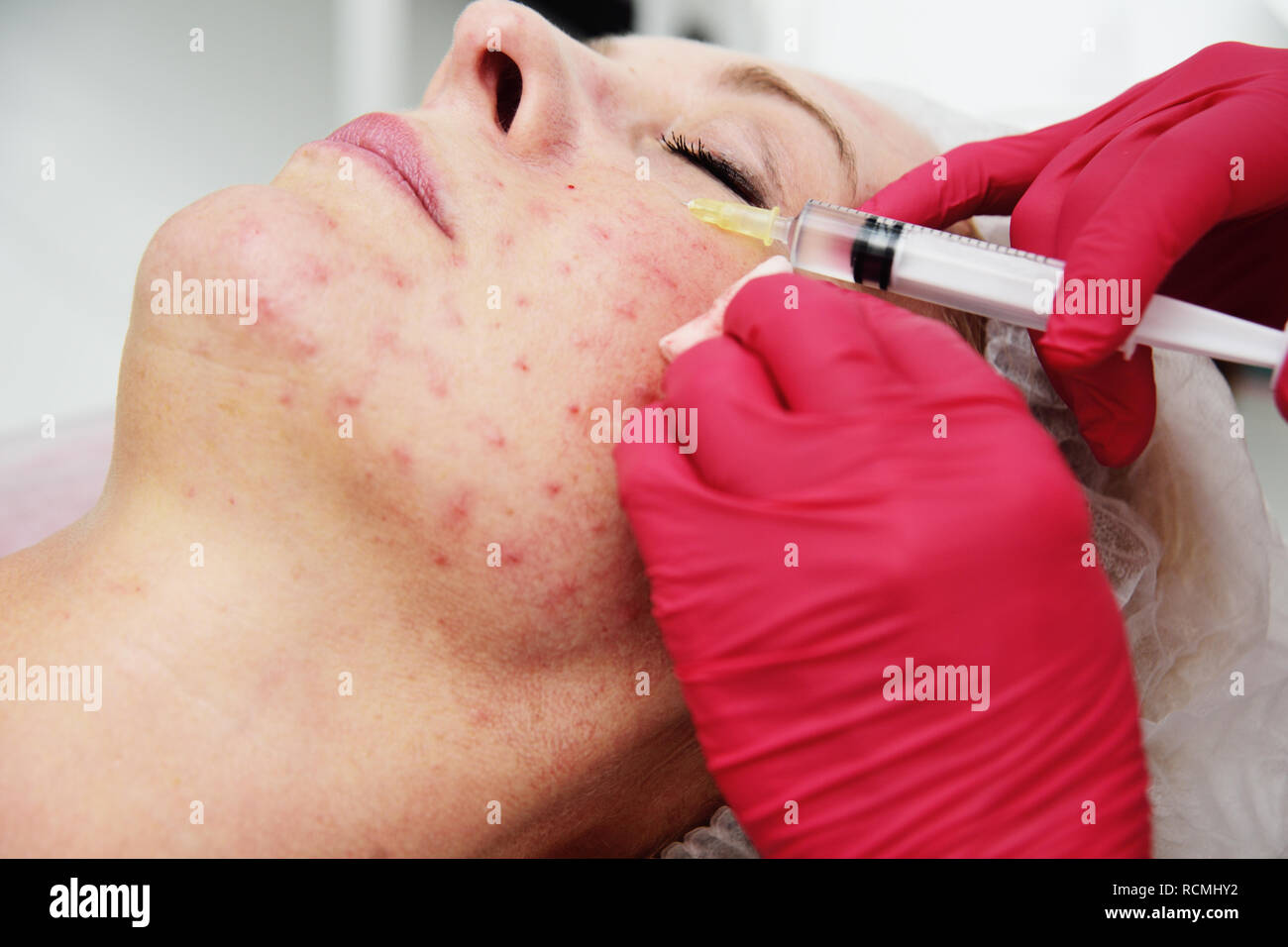 doctor cosmetologist dermatologist conducts a session of mesotherapy for an elderly woman. Stock Photo