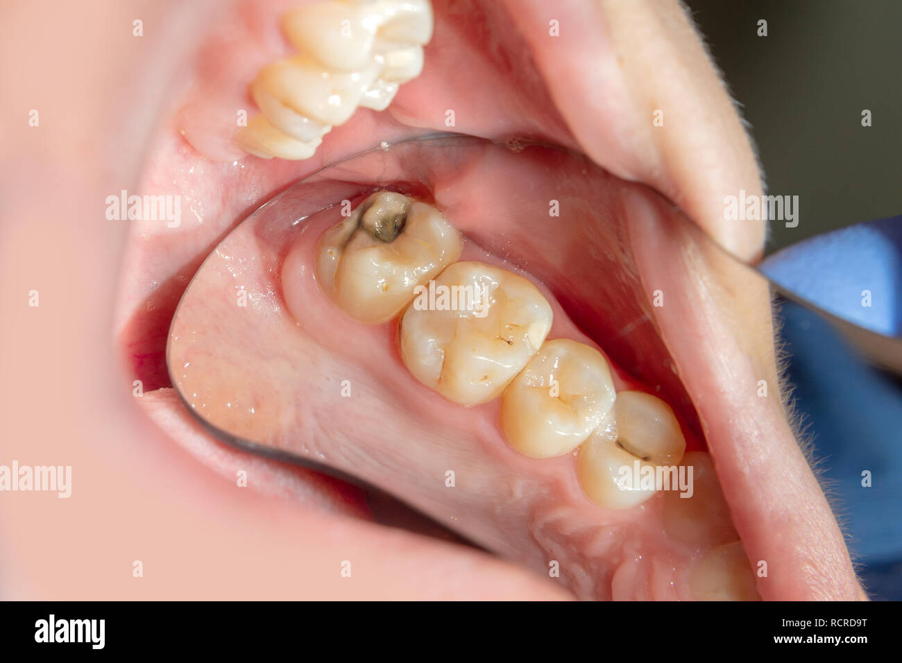 Dental caries. Filling with dental composite photopolymer material
