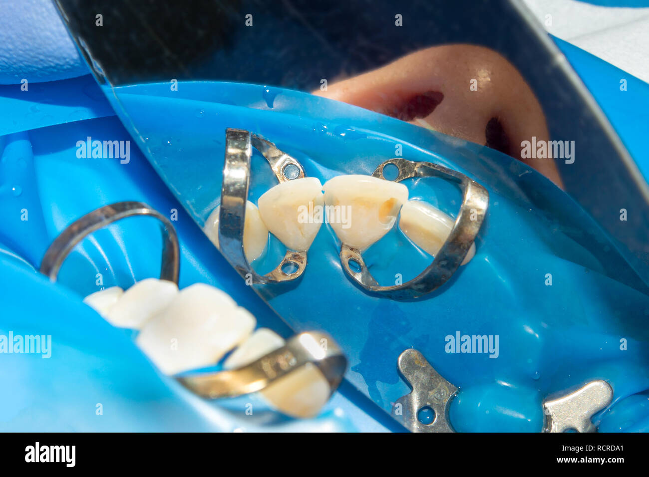 Dental caries. Filling with dental composite photopolymer material