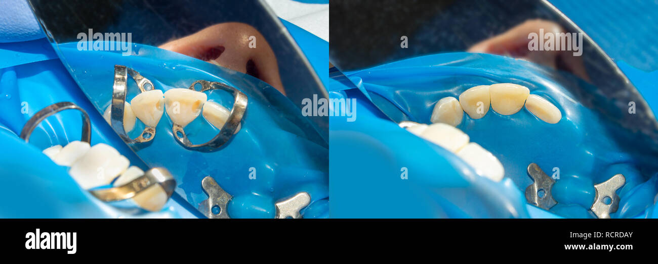 Dental caries. Filling with dental composite photopolymer material