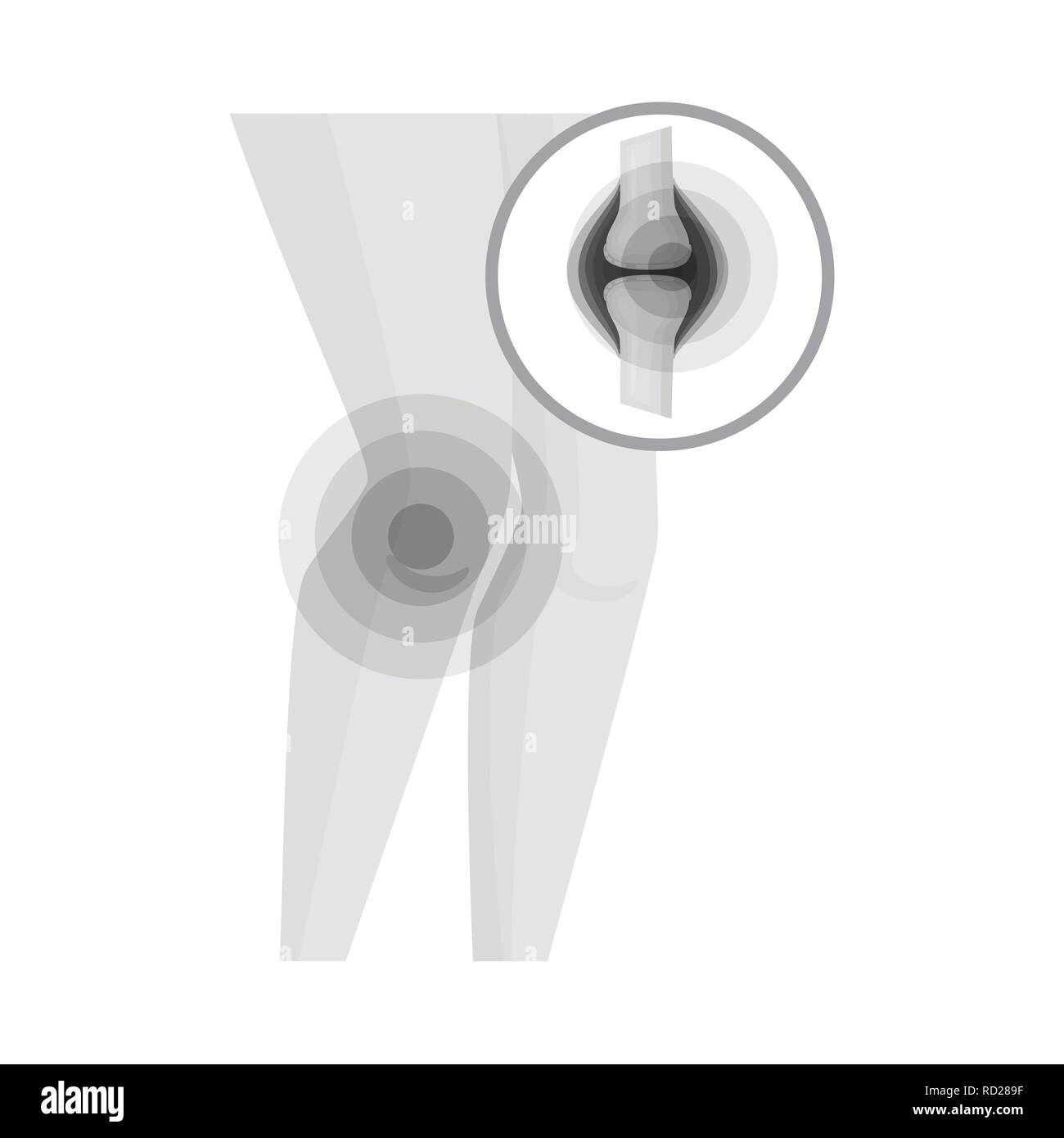 knee,bruise,ligament,cartilage,woman,body,bone,fracture,production,muscle,tendon,suffering