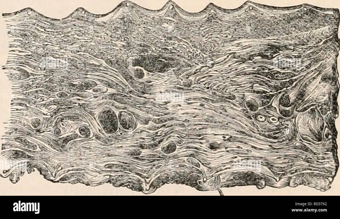 Fibrous tissue in the uterus hi-res stock photography and images - Alamy