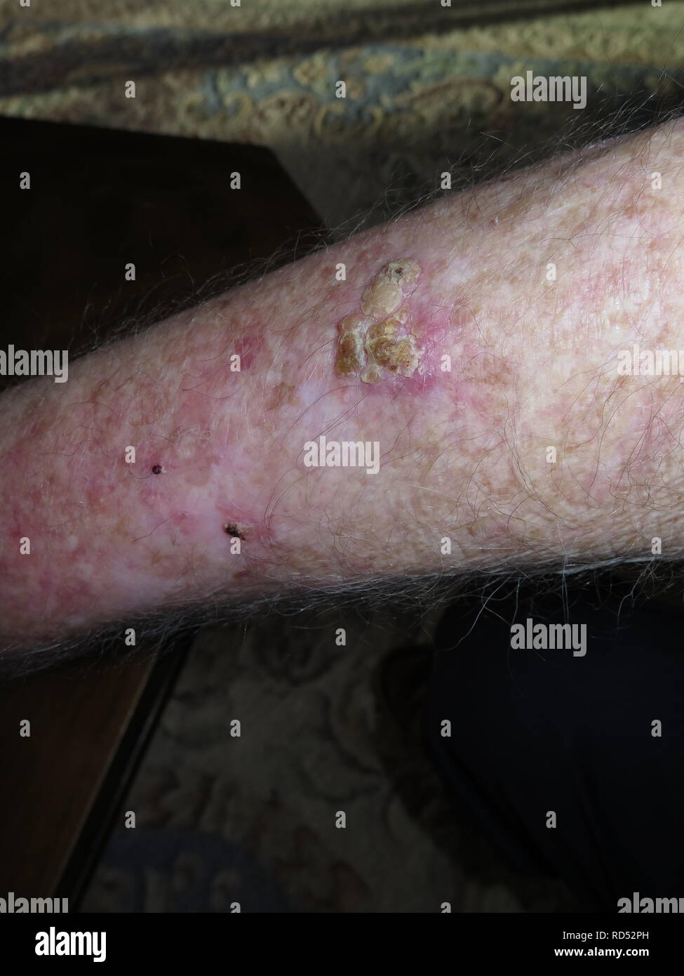 Skin Merkel cell cancer on arm and head of male patient Stock Photo