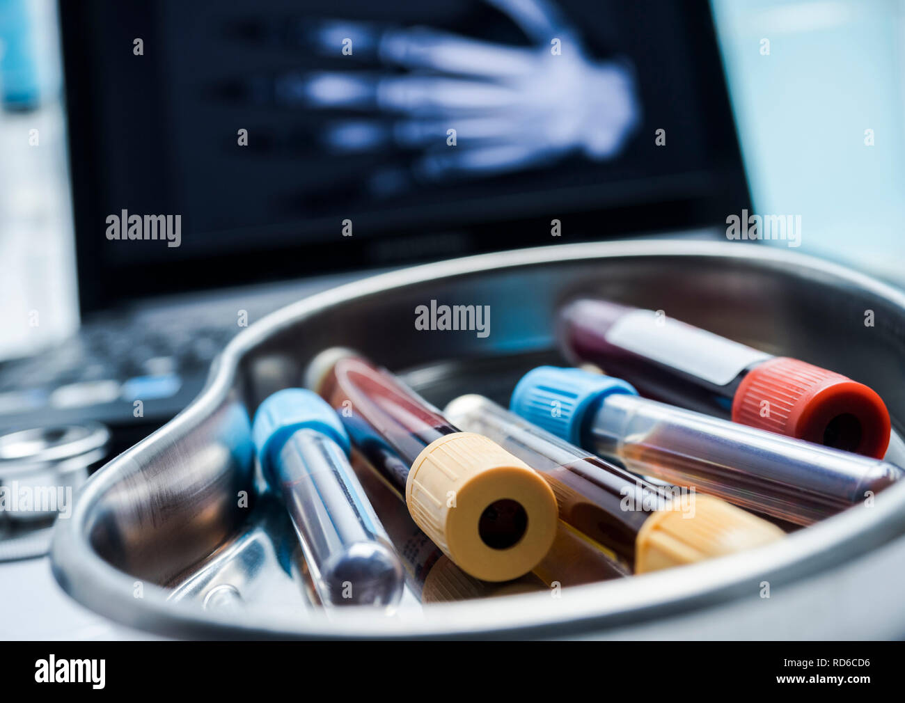 Several vials and blood sample in a metal tray, conceptual image Stock Photo