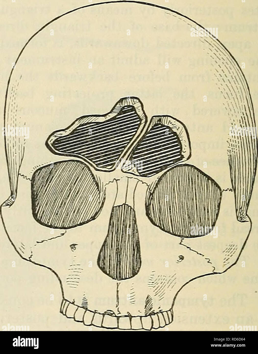 Cunningham S Text Book Of Anatomy Anatomy Fig 1075 Frontal Sinuses Of Average Dimensions With A Medial Septum Logan Turner Fig 1076 A Large Right Frontal Sinus With Septum Oblique To The Left Pdf | the frontal recess and frontal sinus anatomy can vary from simple to complex. alamy
