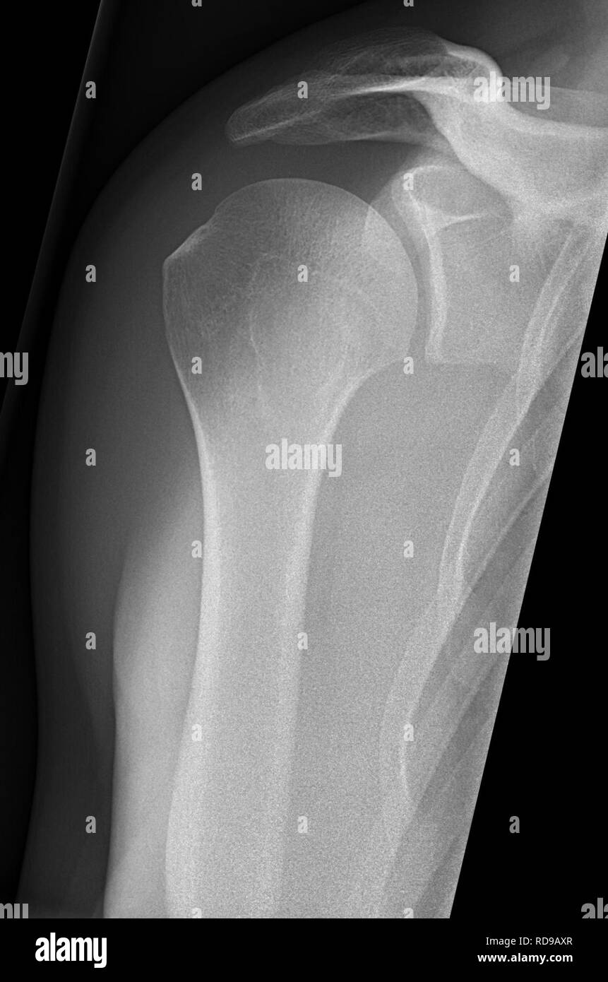 Normal shoulder x ray hi res stock photography and images alamy