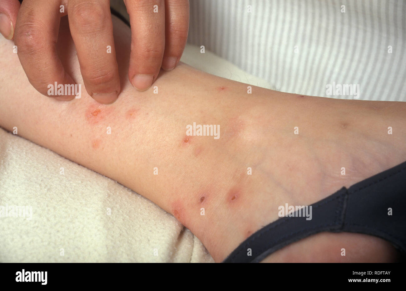 flea bites on person's leg Stock Photo