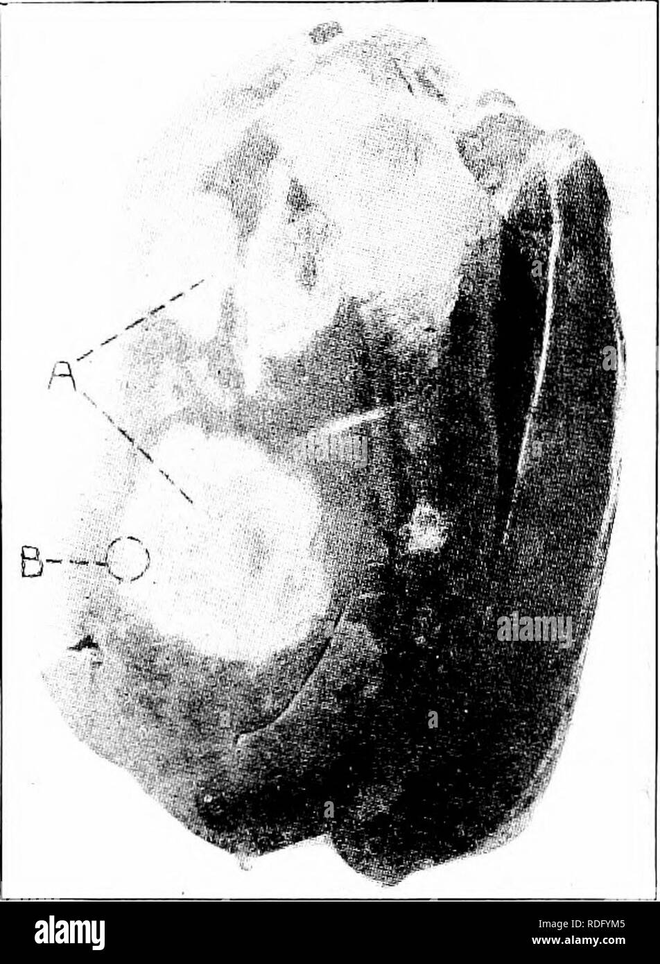 . Animal parasites and parasitic diseases . Domestic animals; Veterinary medicine. 218 PARASITOLOGY.. Fig. 80. Fig. SO.—Liver from a case of Black-Head. En- tero hepatitis, in a turkey. Photograph. This liver weighed 452 grams (about one pound) ; a, indicates the yellowish-white necrotic areas, lesions of the disease.—From Kaupp's Diseases of Poultry.. Please note that these images are extracted from scanned page images that may have been digitally enhanced for readability - coloration and appearance of these illustrations may not perfectly resemble the original work.. Kaupp, Benjamin Franklyn Stock Photo