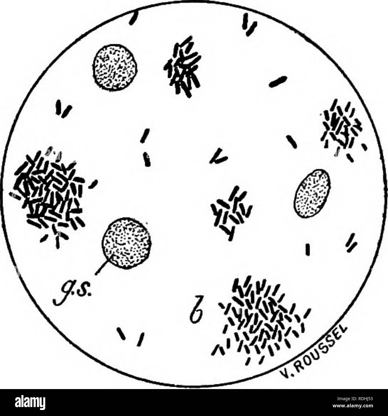. Microbes &amp; toxins. Bacteriology; Toxins; Antitoxins. APPLICATIONS OF BACTERIOLOGY 253. Fig. 71.—Agglutination of the typhoid bacillus by the serum of a typhoid patient: b, clump of bacilli : g.s., blood corpuscles left in the serum. throughout the liquid; the suspension is &quot;homogeneous.&quot; If a trace of serum is added from an animal prepared by injections of typhoid bacilli or from a patient suffering from typhoid fever, the bacilli lose their motility and collect into masses: they are said to become agglutinated by the serum. If the serum is added to a broth culture floccules ca Stock Photo