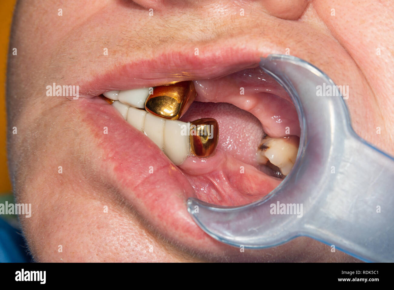 Patient with bad metal dental crowns close-up. The concept of treatment and restoration of aesthetics in  dental clinic Stock Photo