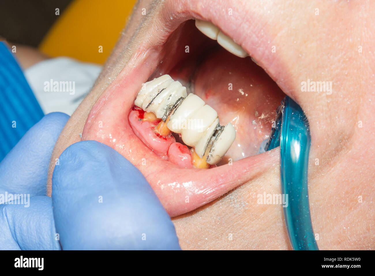 Rotten tooth hi res stock photography and images Alamy