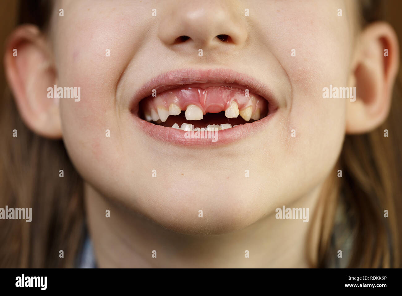 Little girl showing her loose and missing milk teeth. Playful, cheerful childhood, tooth fairy, growth and milestone concept. Stock Photo