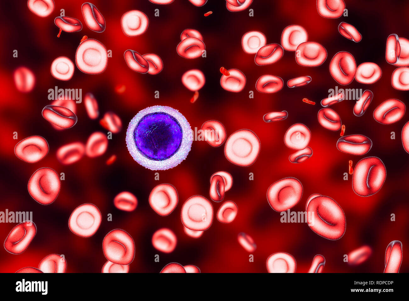 Iron deficiency anaemia. Computer illustration showing hypochromic (stain poorly) and microcytic (small) red blood cells. A small lymphocyte is drawn for size comparison. This is the most common form of anaemia worldwide. It is caused by a deficiency of iron, an essential component of the blood pigment haemoglobin. Symptoms include tired- ness, dizziness, and pale skin. Stock Photo