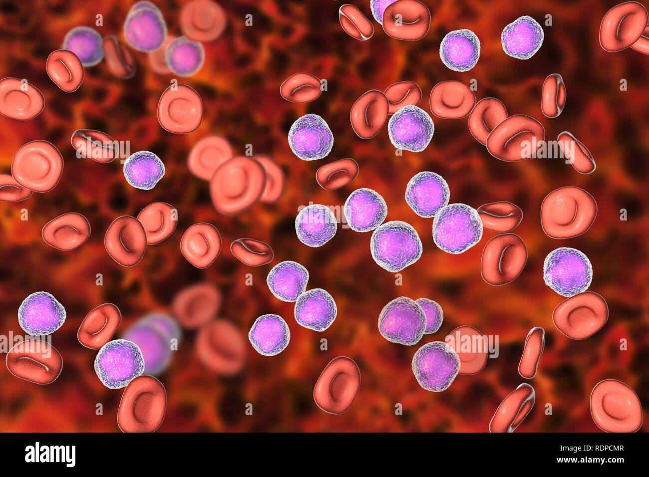 Acute lymphoblastic leukaemia bone marrow smear. Computer illustration  showing abundant lymphoblast cells in human bone marrow Stock Photo - Alamy