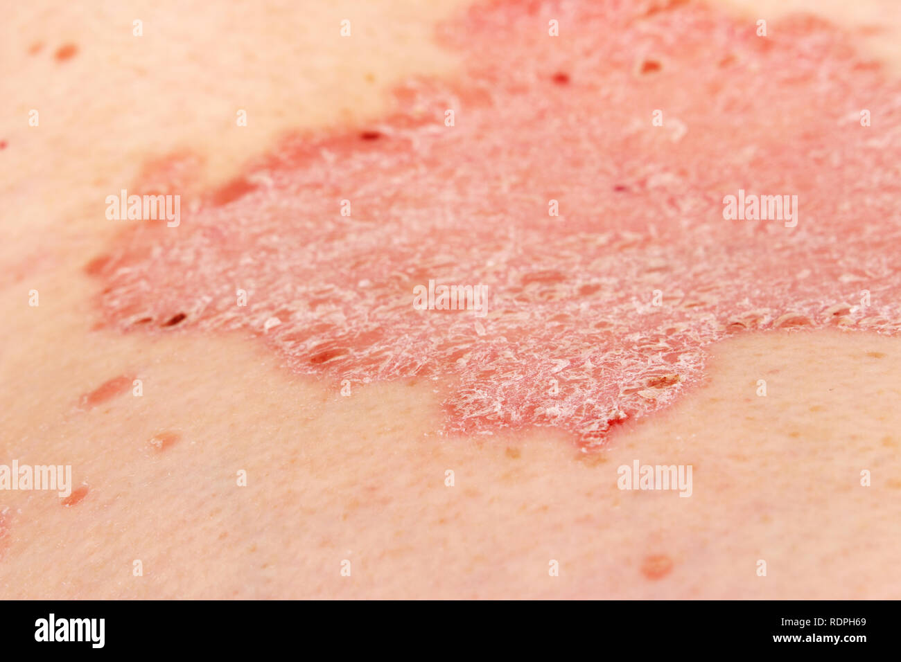 Detail Of Psoriatic Skin Disease Psoriasis Vulgaris With Narrow