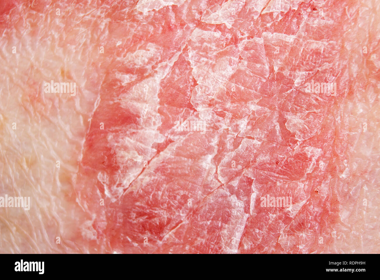 Psoriasis Vulgaris High Resolution Stock Photography and Images Alamy