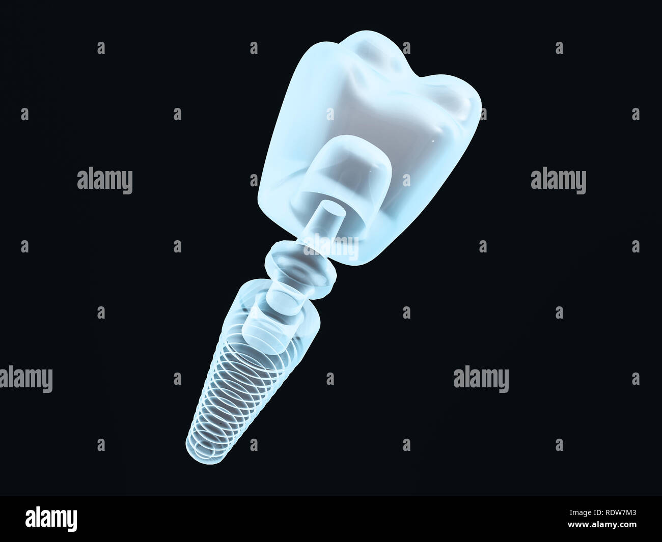 Dental implant dentist, tooth layout, plastics, man, teeth treatment 3D ...