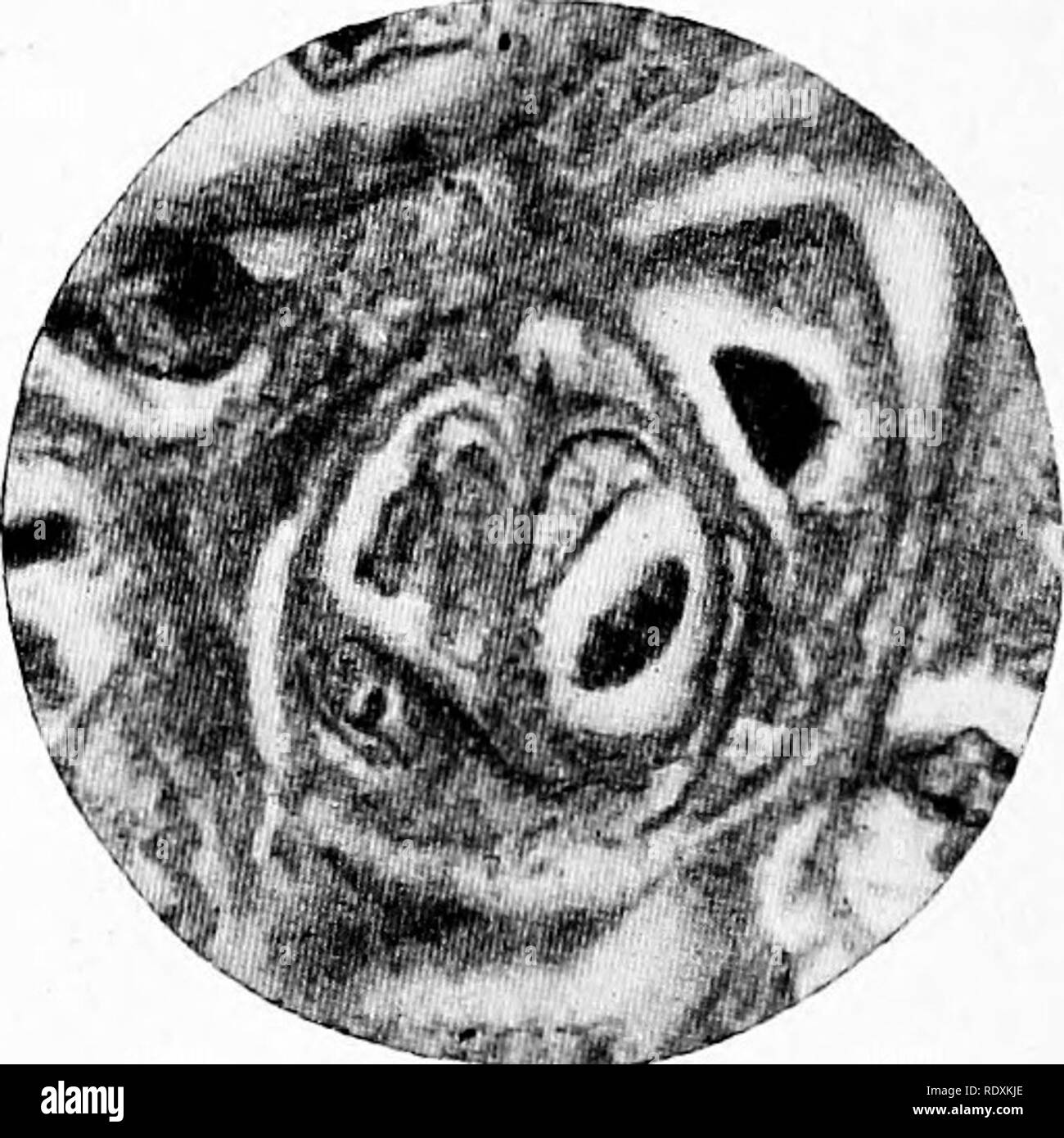 . Protozoo?logy. Protozoa; Protozoa, Pathogenic. Cytoryctes variolae in different stages of niuitipiication, outside iarst three figures and outside last two figures of tiie nucleus, (Alter Calkins.). -^^stsaitJ^ Two of the larger cytoplasmic forms of cytoryctes in the epithelium. The two dark bodies in the middle showing reticular structure are the parasites. XIOOO. like nucleophaga, develop in a more definite manner. Chromidial fragments are formed, varying in size and character, while a residual portion of the chromatin, analogous to the residual nucleus of free living rhizopods, remains un Stock Photo