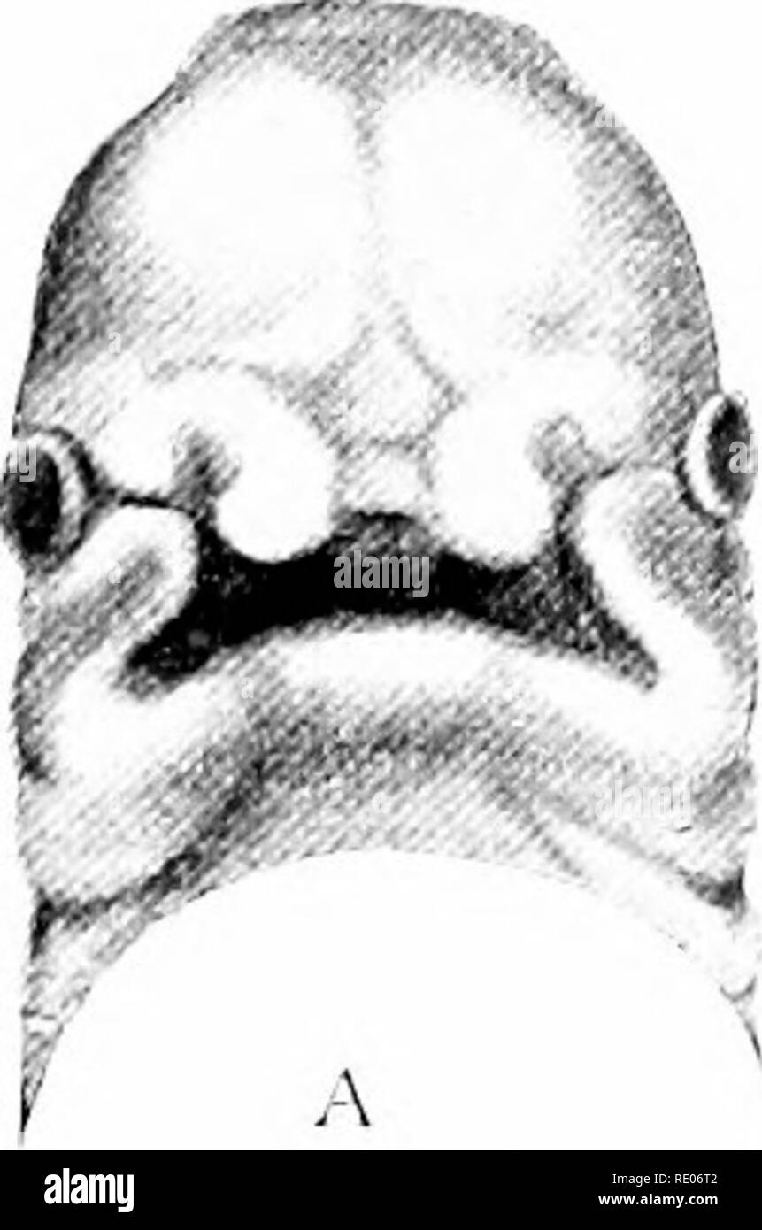 Cleft palate Black and White Stock Photos & Images - Alamy