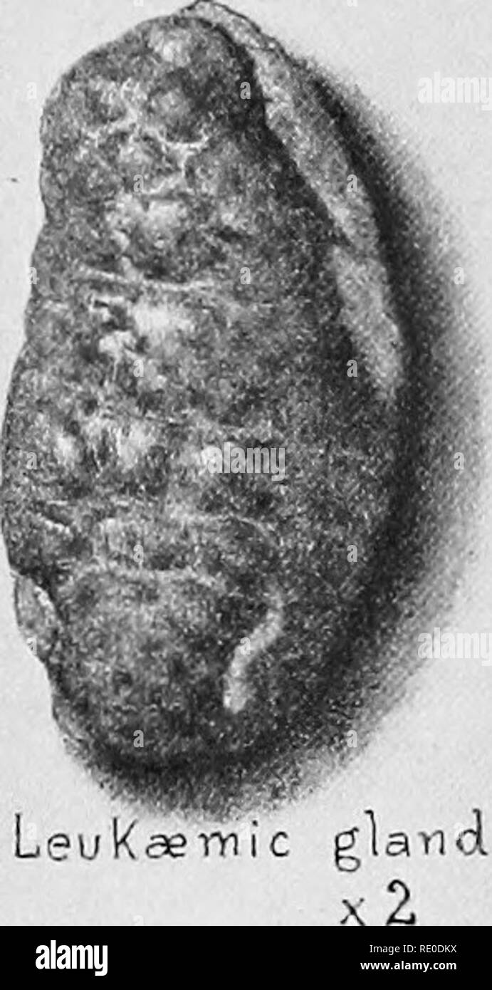 . Leukaemia of the fowl: spontaneous and experimental. Leukemia; Poultry. THE JOHNS HOPKINS HOSPITAL REPORTS. PLATE II. NormaTglancU: xZ. Please note that these images are extracted from scanned page images that may have been digitally enhanced for readability - coloration and appearance of these illustrations may not perfectly resemble the original work.. Schmeisser, Harry Christian, 1885-. Baltimore, The John Hopkins Press Stock Photo