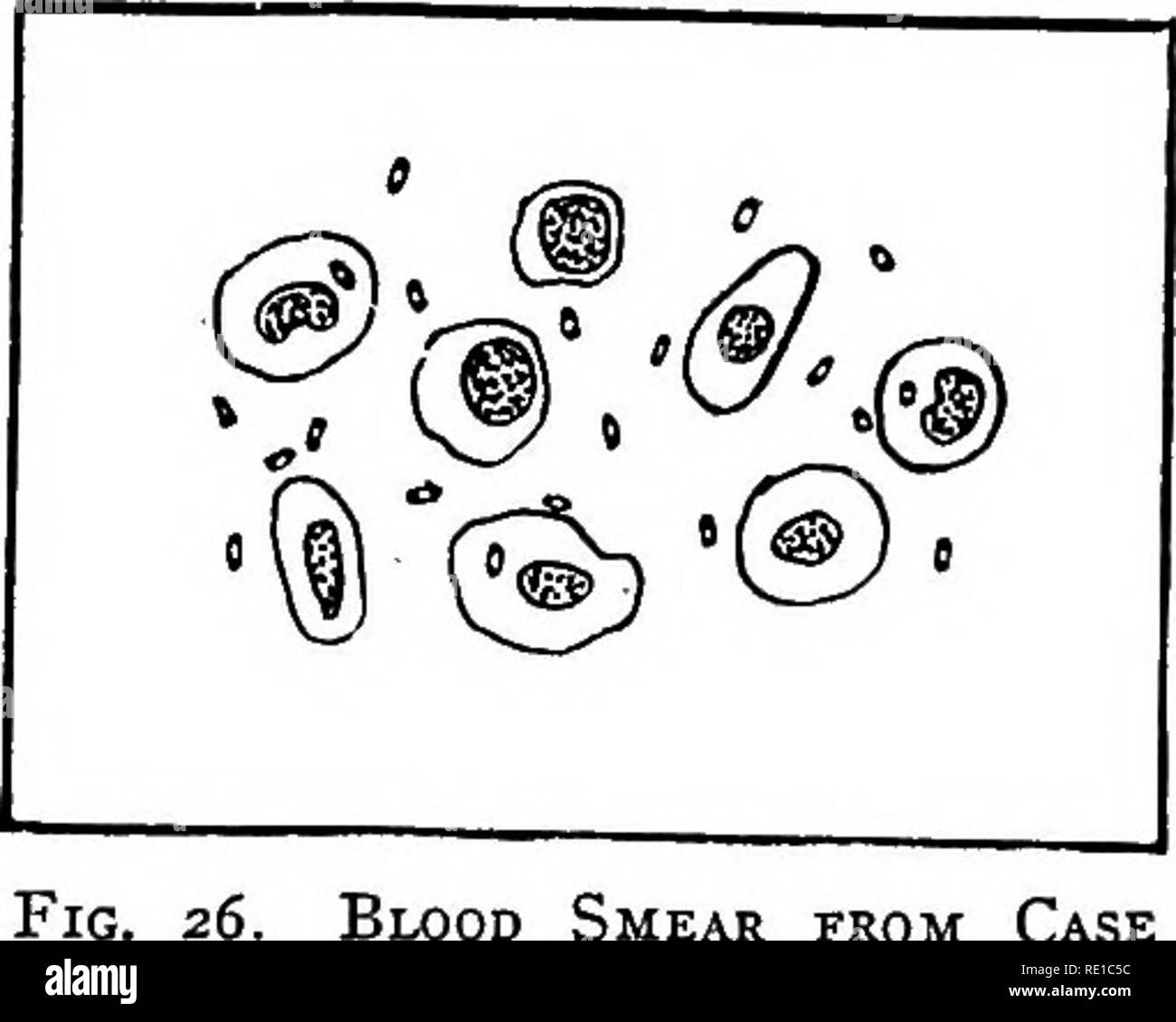 . Poultry diseases and their treatment. Poultry. 80 POULTRY DISEASES of blood cells. One of these, a white-blood cell (phagocyte), has taken up one of the germs. Mode of Spread.— Birds often contract this dis- ease from others at shows, and when taken back home infest the remainder of the flock and the premises, or a bird recently purchased from an infected flock, or eggs from an infected flock, or chicks recently hatched in infected sur- roundings, or infected droppings carried on the feet of men and animals, from hen- houses where the disease exists, or carried by streams or irrigation ditch Stock Photo