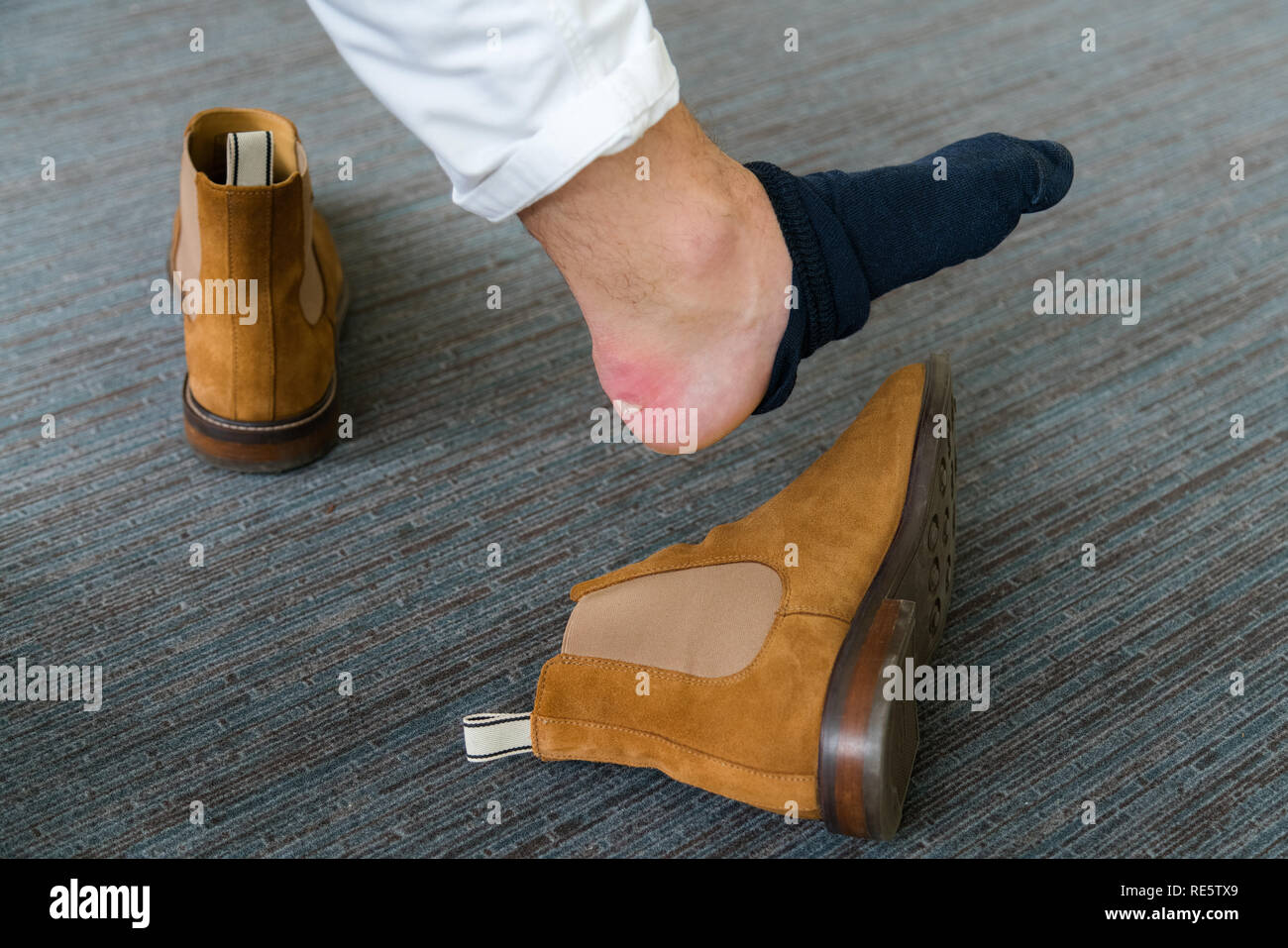 Painful Heel wound on mans feet caused by new shoes. Cracked terrible