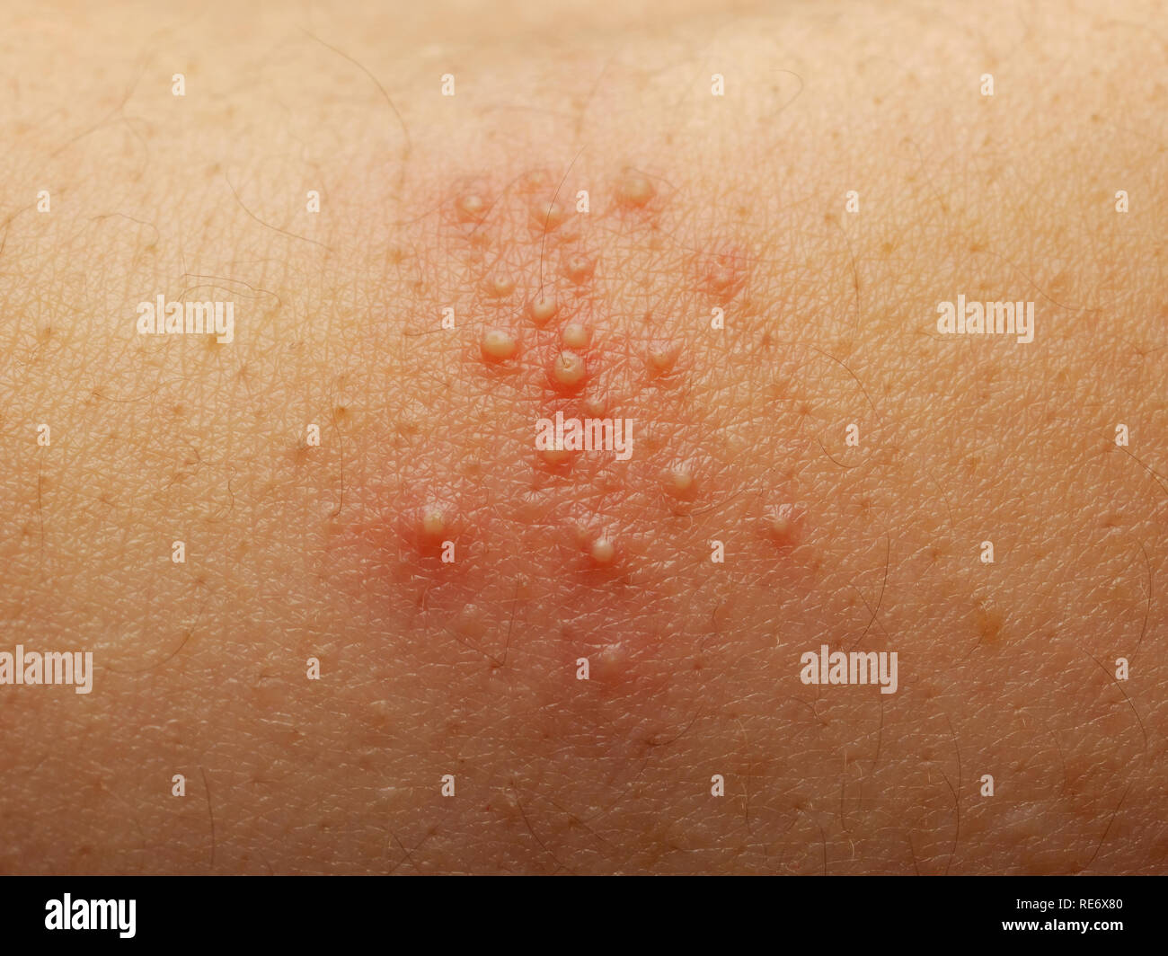 Skin Rash Caused By Mold