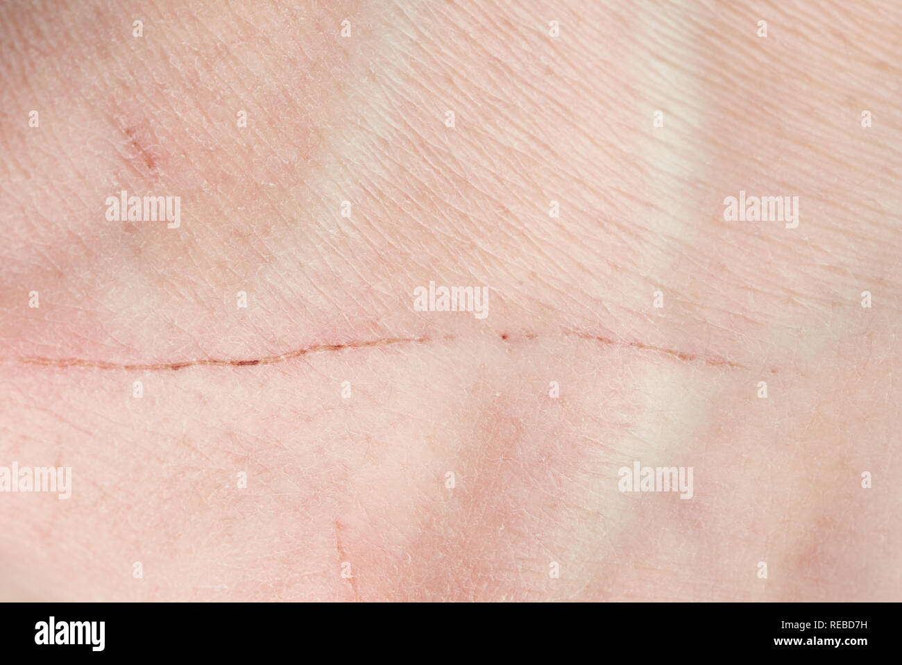 Scratch on human skin close up. Long cut on human skin Stock Photo