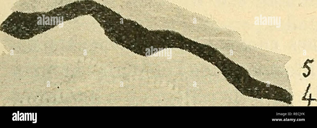 Ulcus Rodems Ulcus rodens hi-res stock photography and images - Alamy