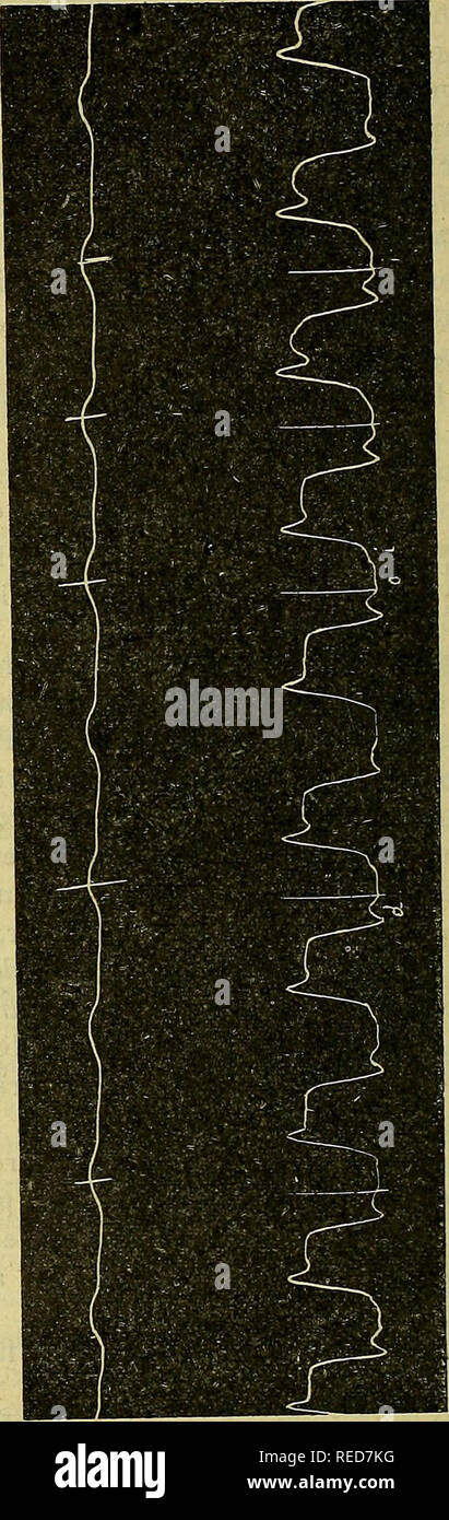 . Comptes rendus des séances de la Société de biologie et de ses filiales. Biology. *o. *o Pc (1) Dans le dernier Liera des tracés (flg. 1) dissociation auriculo-ventriculaire due à une excitation électrique légère du vague: la systole auriculaire, qui ne se traduisait pas antérieurement, se traduit alors sur le ventricule plus relâché et, l'évacuation auriculaire rencontrant moins de résistance, la systole auriculaire est aussi plus ample. Dans ce cas on ne voit pas l'accident inter- systolique i, ce qui démontre bien son origine ventriculaire.. Please note that these images are Stock Photo
