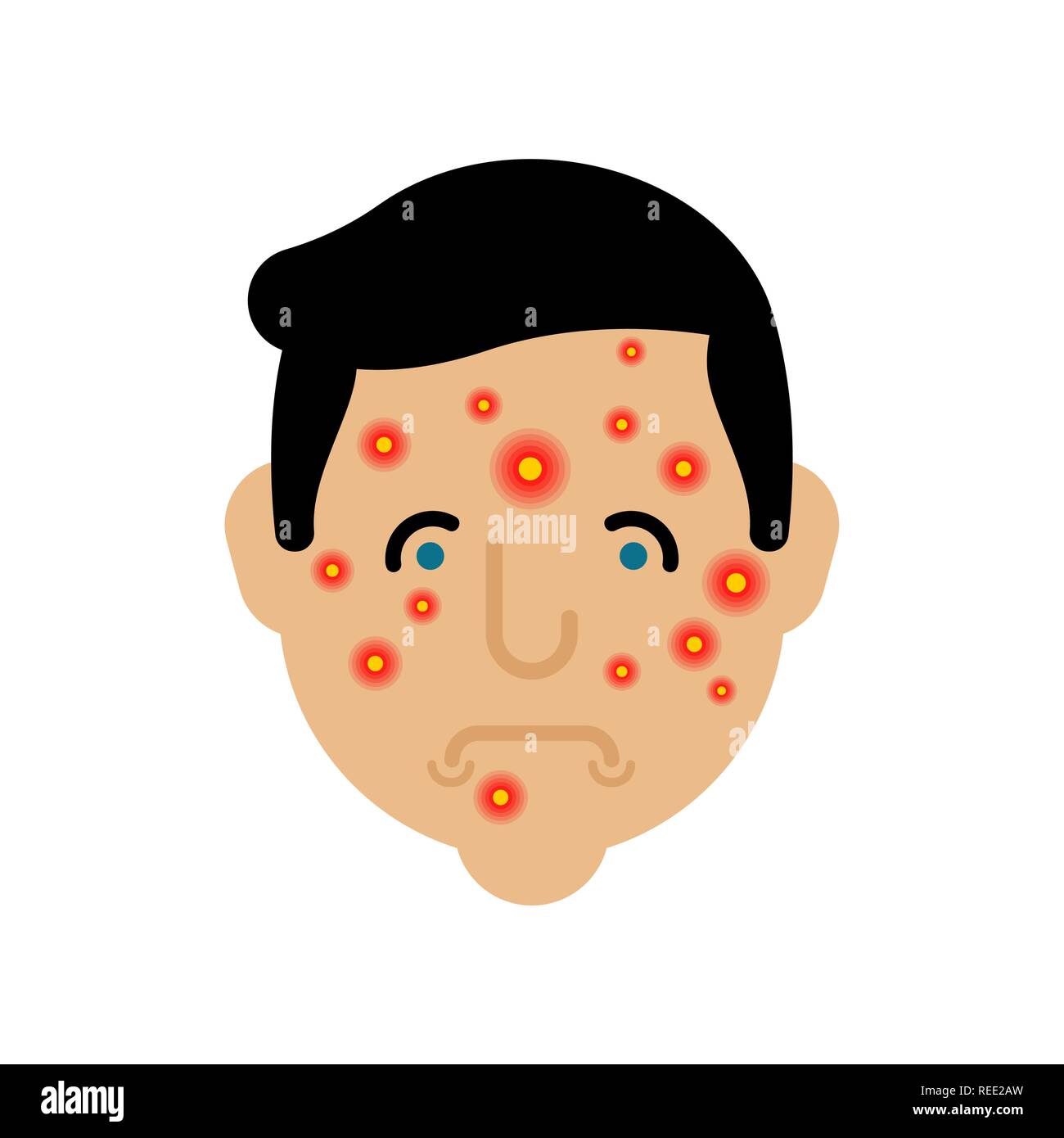 Acne on face man. Pimples on skin male Stock Vector