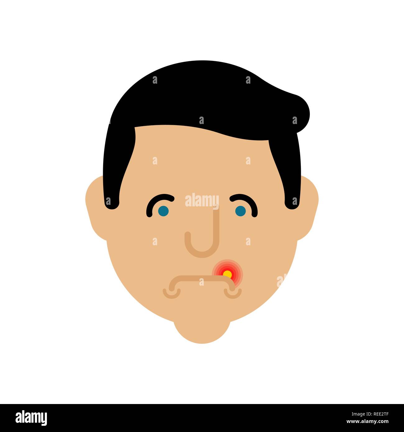 Herpes on lip man. Cold on mouth male Stock Vector