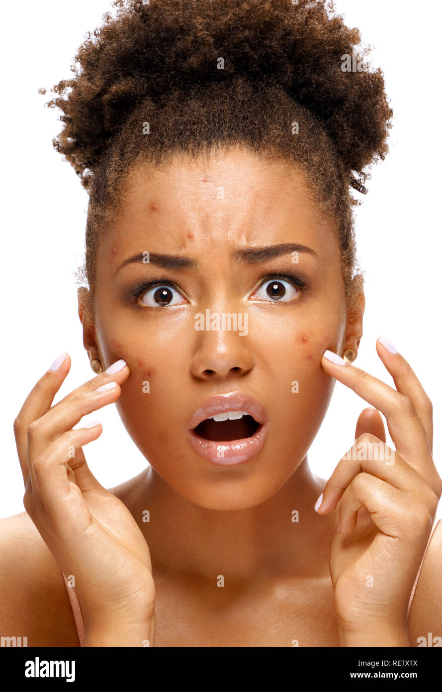 Ugly teen girl in shock of her acne. Photo of african american girl with problem skin on white background. Skin care concept Stock Photo