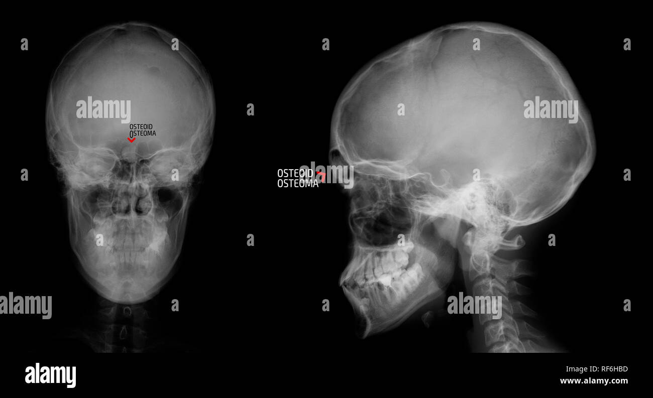 Frontal Sinus High Resolution Stock Photography And Images Alamy