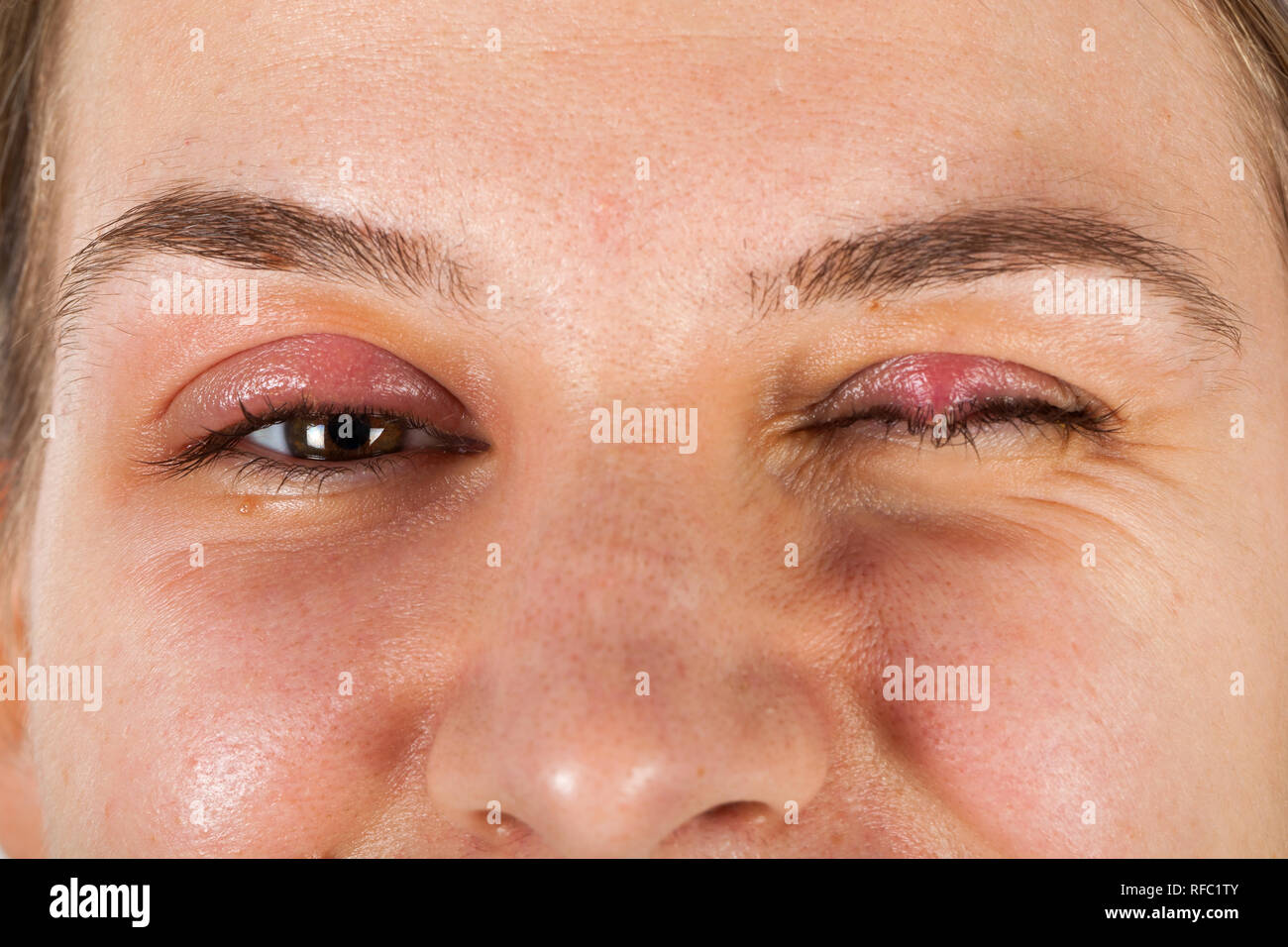 Young female suffering from chalazion - upper eyelid inflammation. viral infection. Looking to the camera on isolated Stock Photo