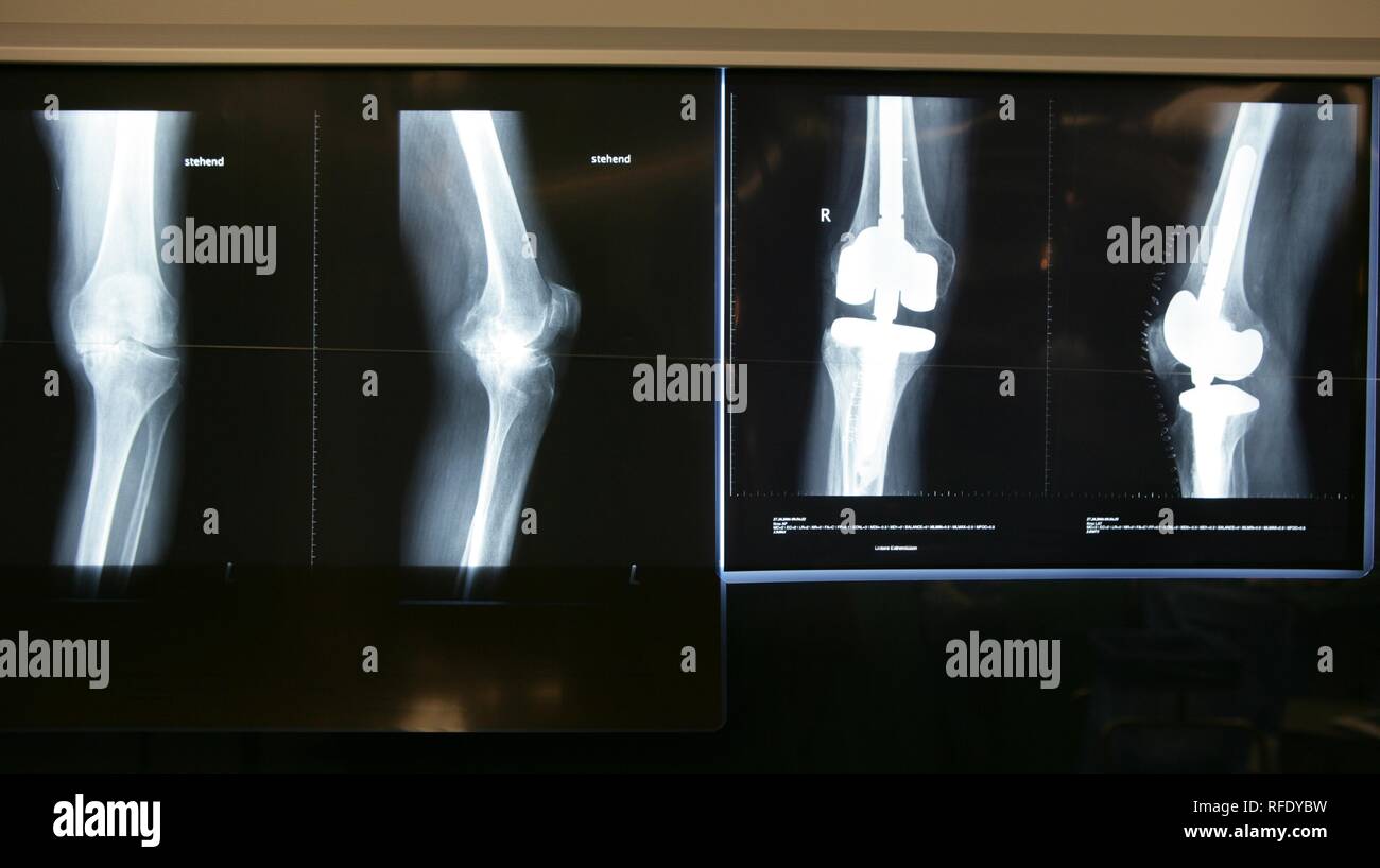 X-ray photo of an artificial knee joint, knee replacement Stock Photo