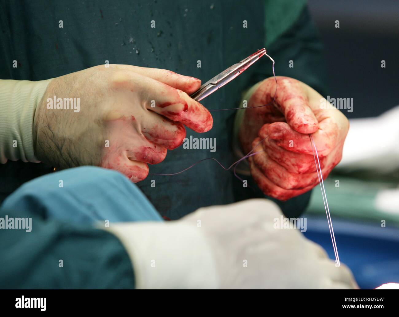 Surgeon stitching an operation wound Stock Photo