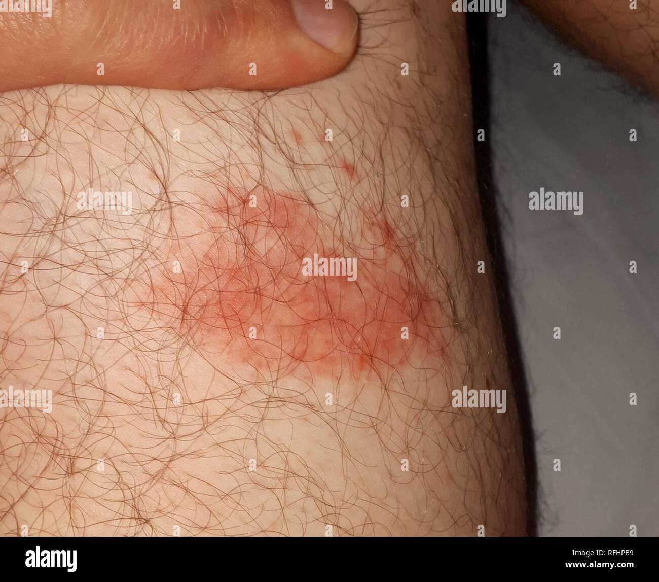 Atypical erythema migrans 1 week after initial presentation. Stock Photo