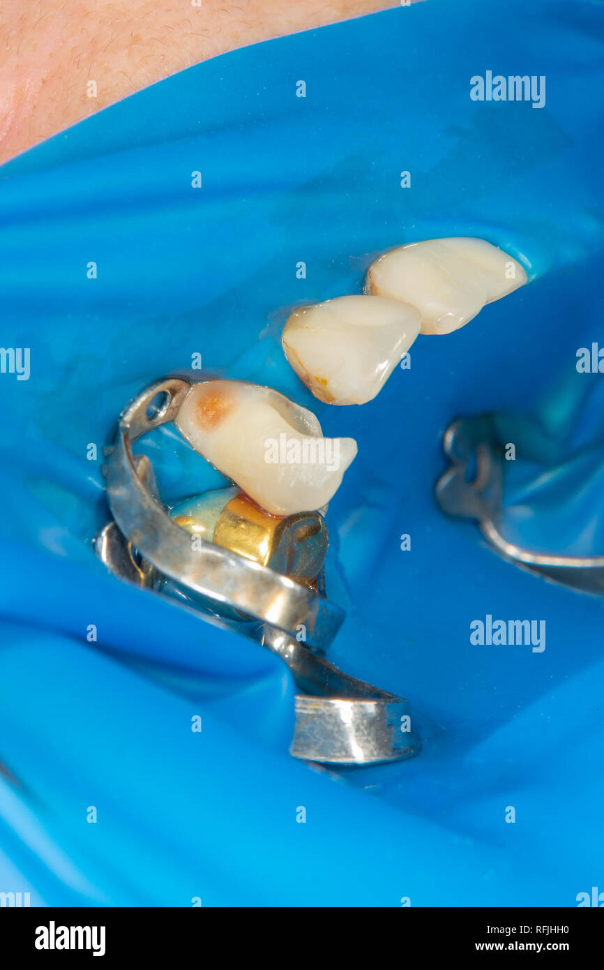 Dental caries. Filling with dental composite photopolymer material