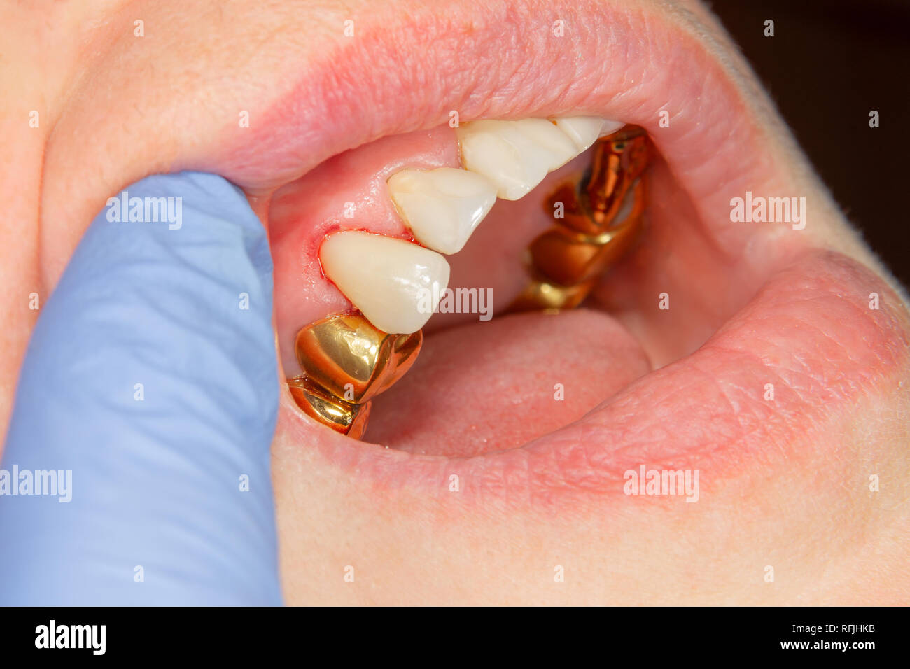 Dental caries. Filling with dental composite photopolymer material using rabbders. The concept of dental treatment in a dental clinic Stock Photo