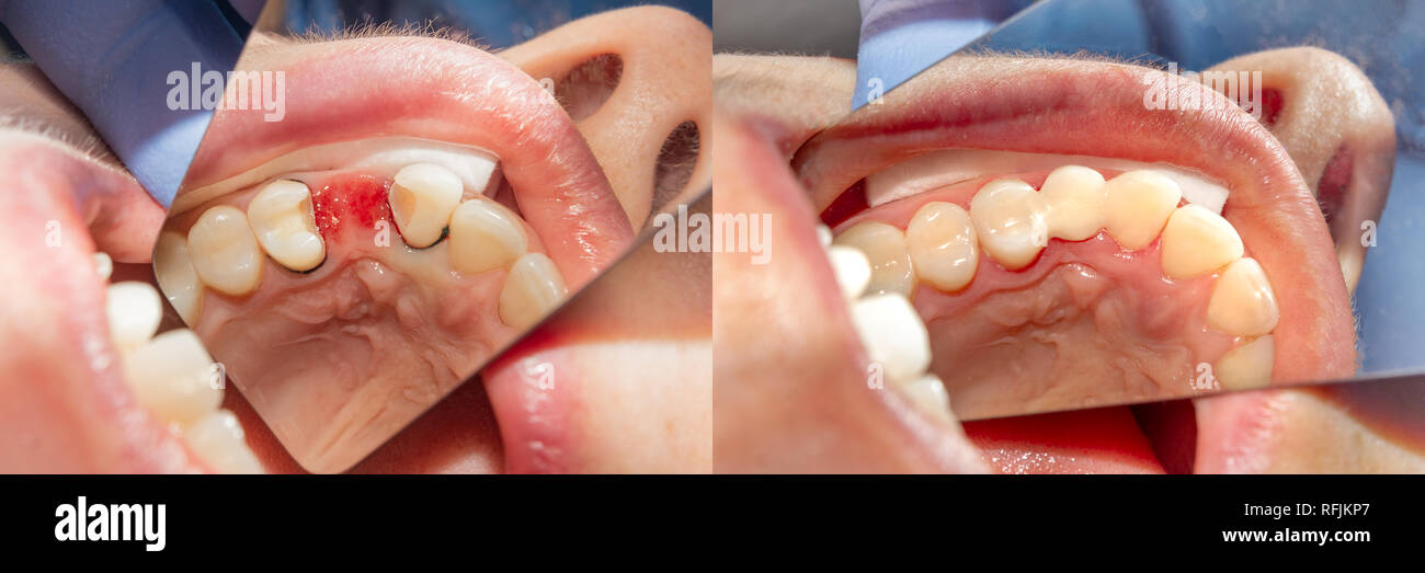 filling and restoration of tooth loss with adhesive composite material closeup. Concept before