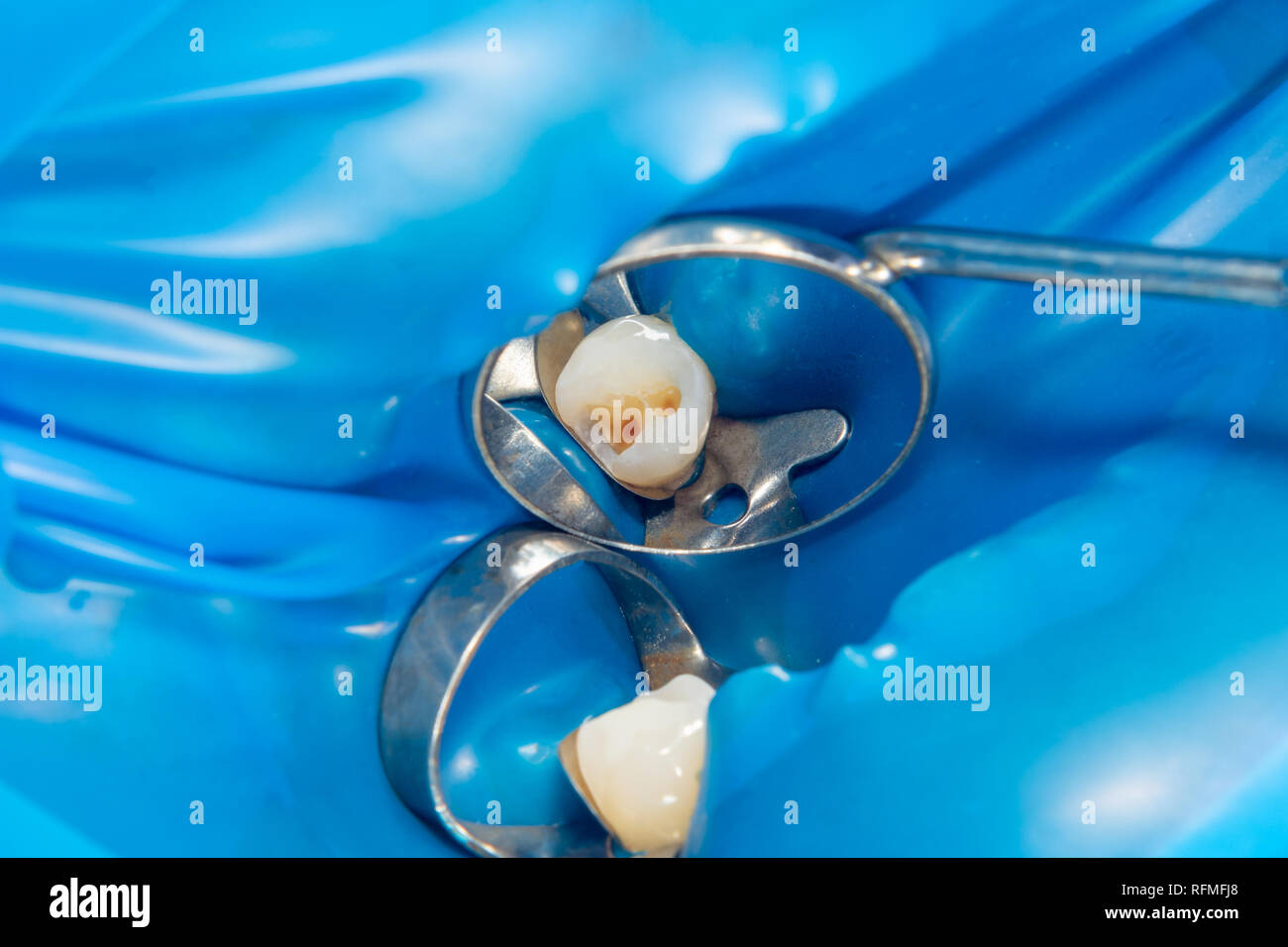 Dental caries. Filling with dental composite photopolymer material