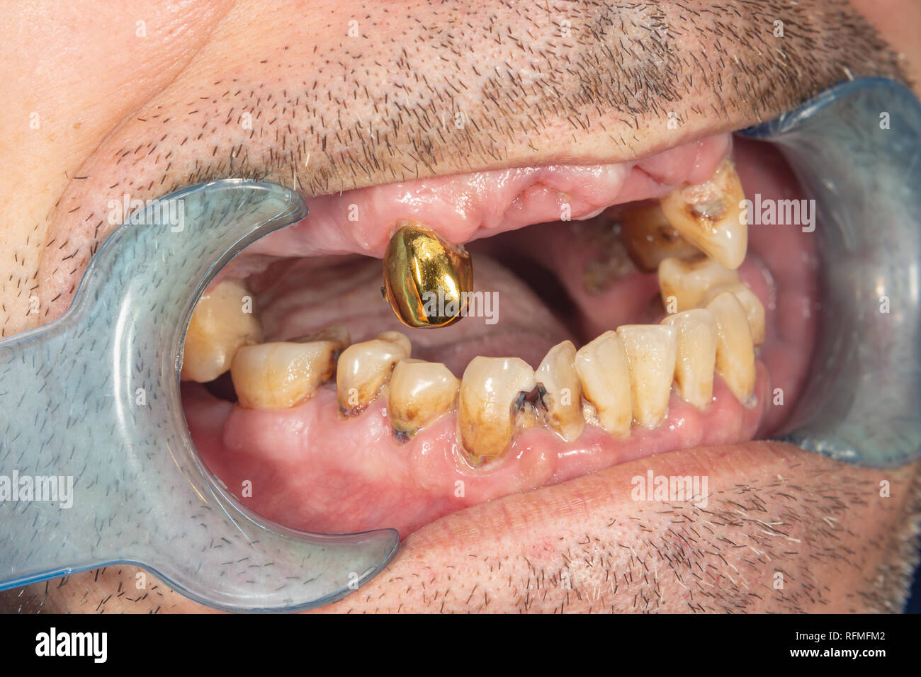rotten teeth, caries and plaque close-up in an asocially ill patient. The  concept of poor hygiene and health problems Stock Photo - Alamy