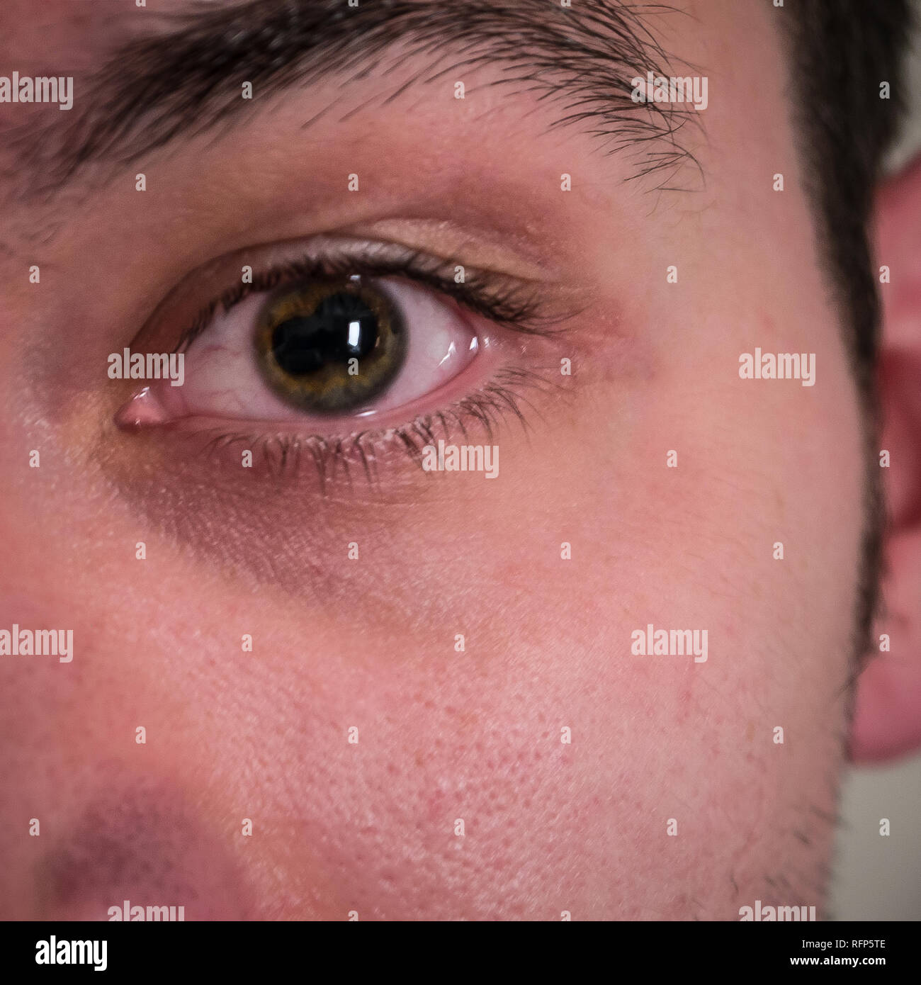 Closeup of male eye with split pupil from iritis / uveitis eye disease Stock Photo