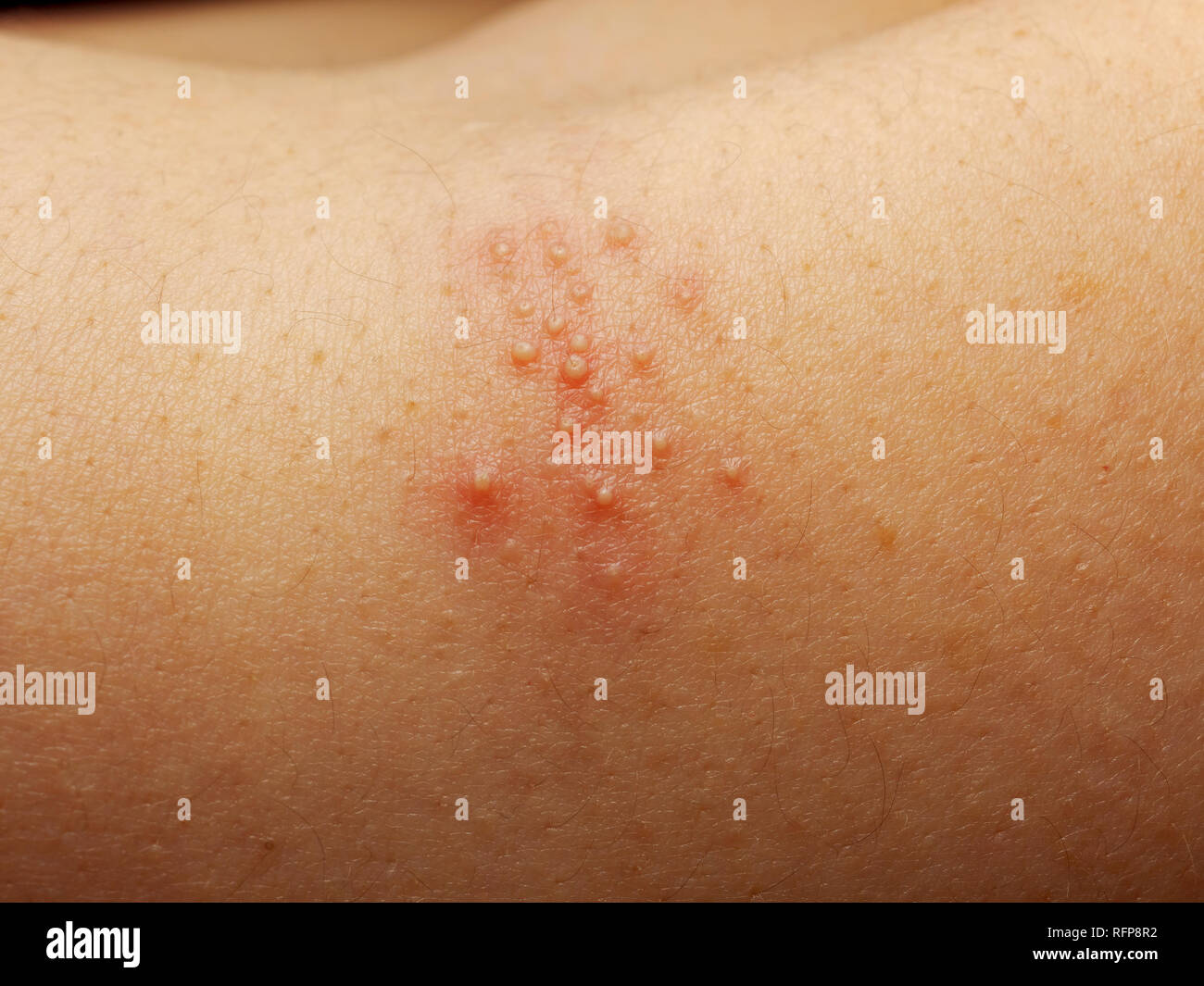 Close up of girl has rash and other nonspecific skin eruption on her