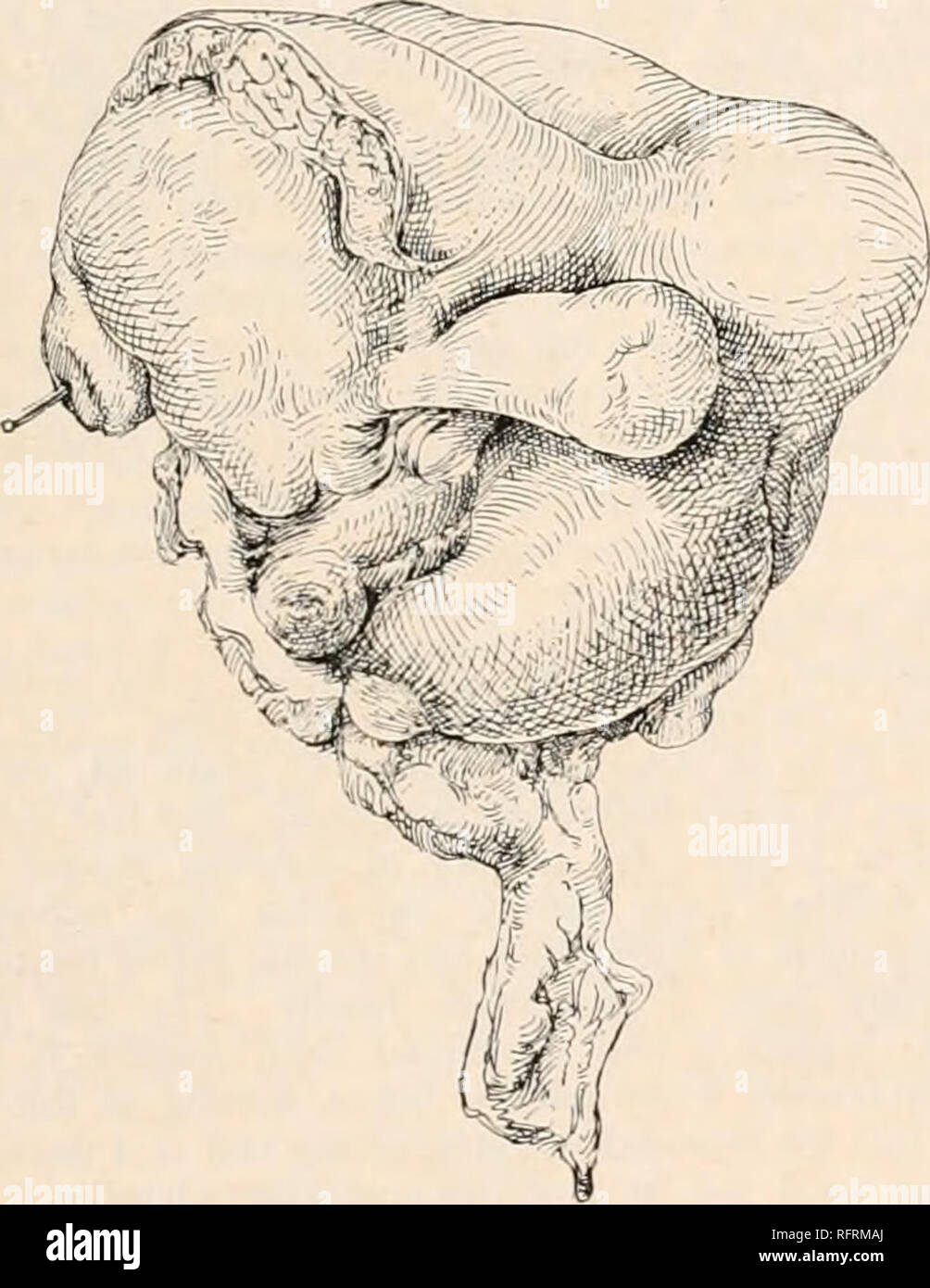 . Carnegie Institution of Washington publication. ON THE FATE OF THE HUMAN EMBRYO IN TUBAL PREGNANCY. 85 No. 762 (Dr. Leonard, Baltimore.) Unruptured tubal mass, 65X45X35 mm. From a white woman, who has been married 6 years. Soon after marriage she missed four periods and then aborted. The last period began on August It, 1913, the previous one having occurred on July 3. After the last period there were bleeding and pain until the operation, which took place September 24. The uterus was found somewhat enlarged and covered with adhesions. The left tube and the ovary were found plastered to the s Stock Photo
