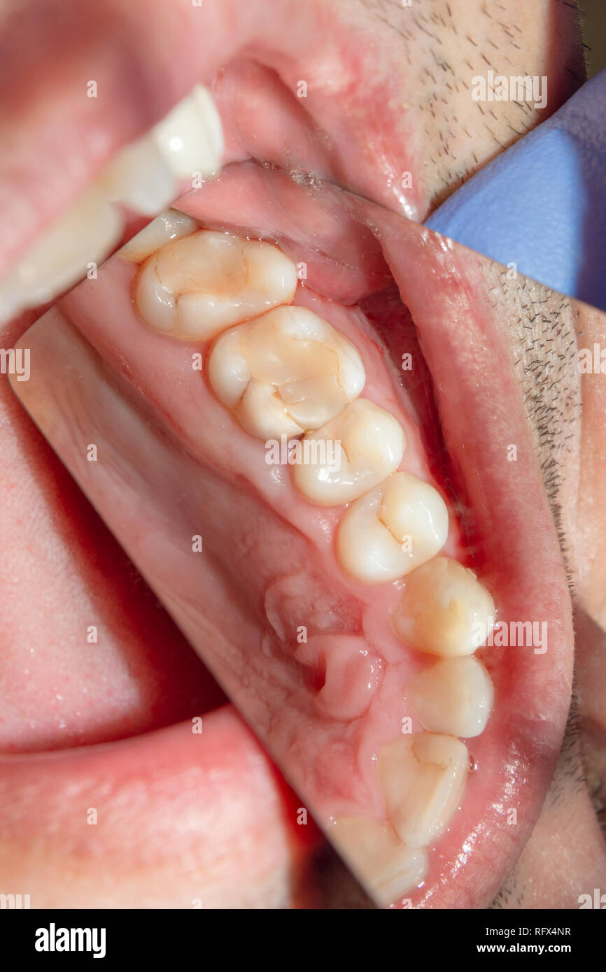 Dental caries. Filling with dental composite photopolymer material