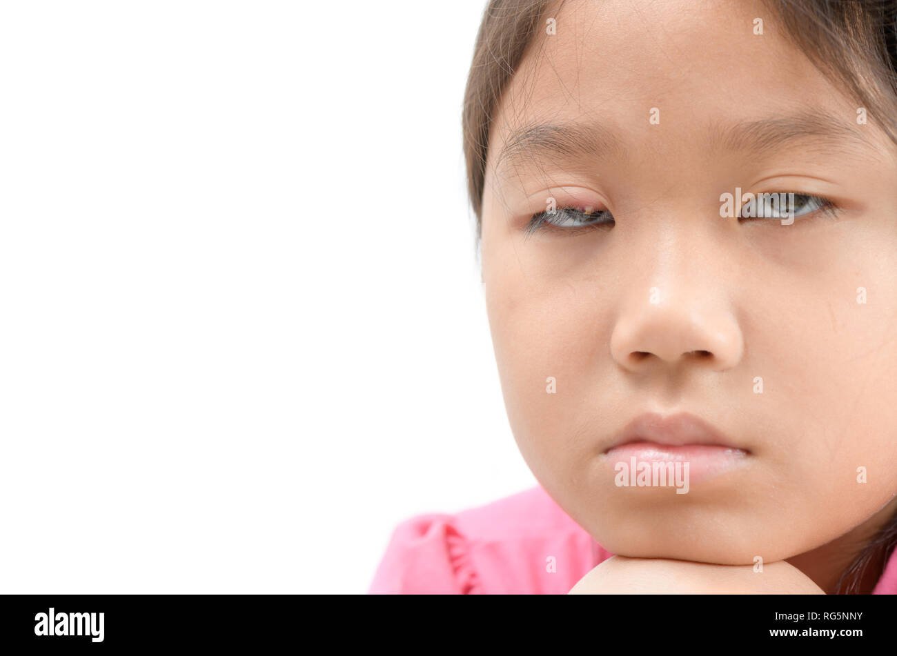 Sad girl one eye infection isolated on white background, eyelid abscess, stye, hordeolum. Concept of health, disease Stock Photo